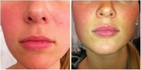 Filler treatmnt before and after